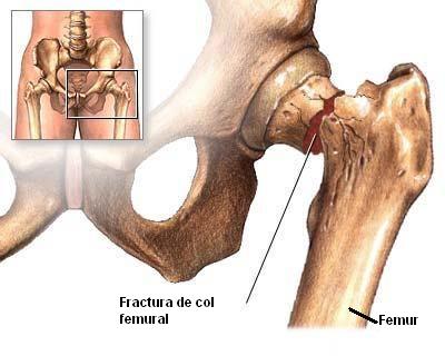 Fractura de col femural